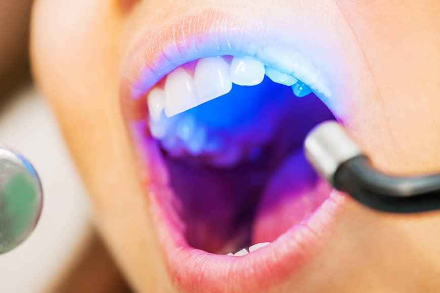 ultraviolet dental treatment.